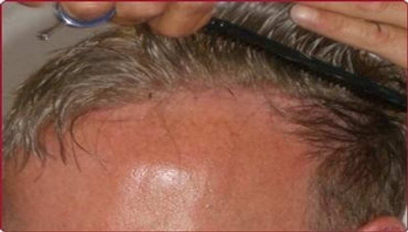 Clínica de Implante de cabelo em Mauá