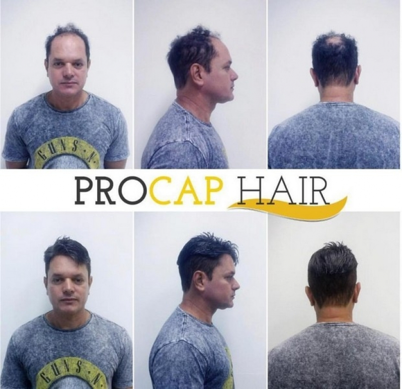 Implantes de cabelo onde encontrar em São Carlos