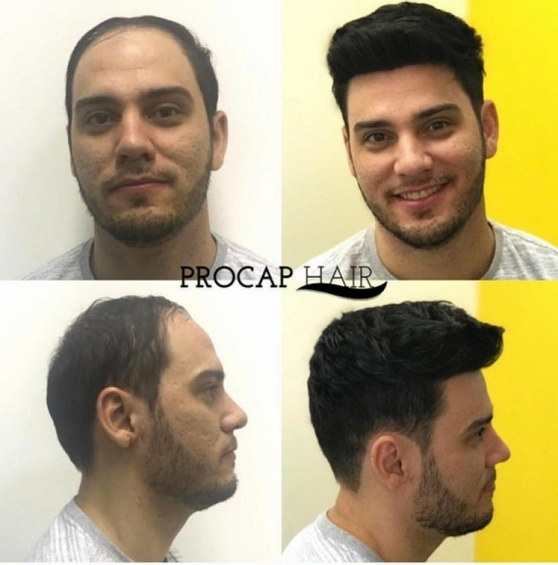 Qual preço de um Implante de cabelo não cirúrgico em São Carlos