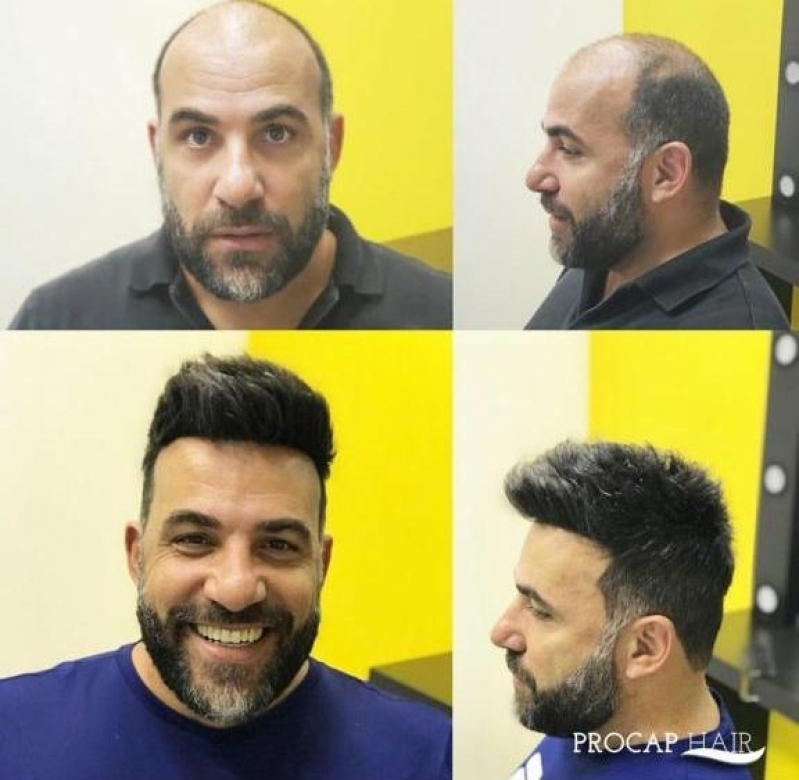 Clínica que faz Prótese de cabelo masculino na Raposo Tavares