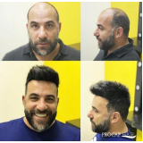 Implante de Cabelo sem Cirurgia Valor Implante de Cabelo sem Cirurgia Valor