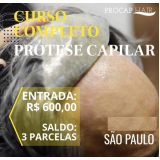 Implante de Cabelo Masculino em SP Implante de Cabelo Masculino em SP