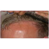 Preços de Implantes Capilares Masculinos Preços de Implantes Capilares Masculinos