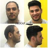 Manutenção de Prótese Capilar com Tela Frontal Manutenção de Prótese Capilar com Tela Frontal