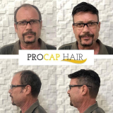 Manutenção de Prótese Capilar Invisível Manutenção de Prótese Capilar Invisível