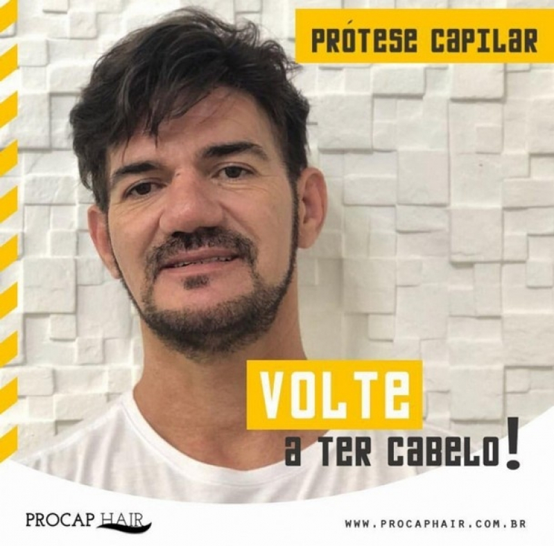Onde encontrar Prótese de cabelo masculino na Casa Verde Onde encontrar Prótese de cabelo masculino na Casa Verde