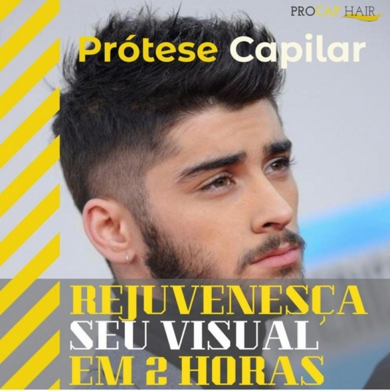 Onde tem Tratamentos para calvice barato em Limeira