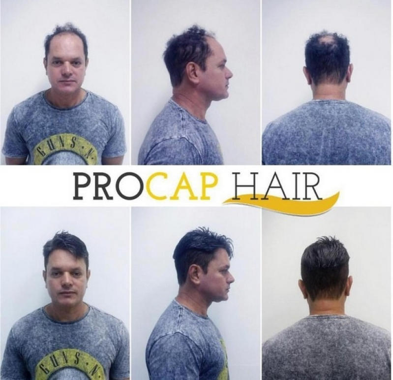 Próteses capilares masculinas em Artur Alvim Próteses capilares masculinas em Artur Alvim