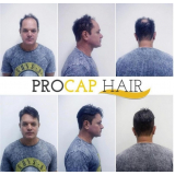 Próteses Capilares para Homens Próteses Capilares para Homens
