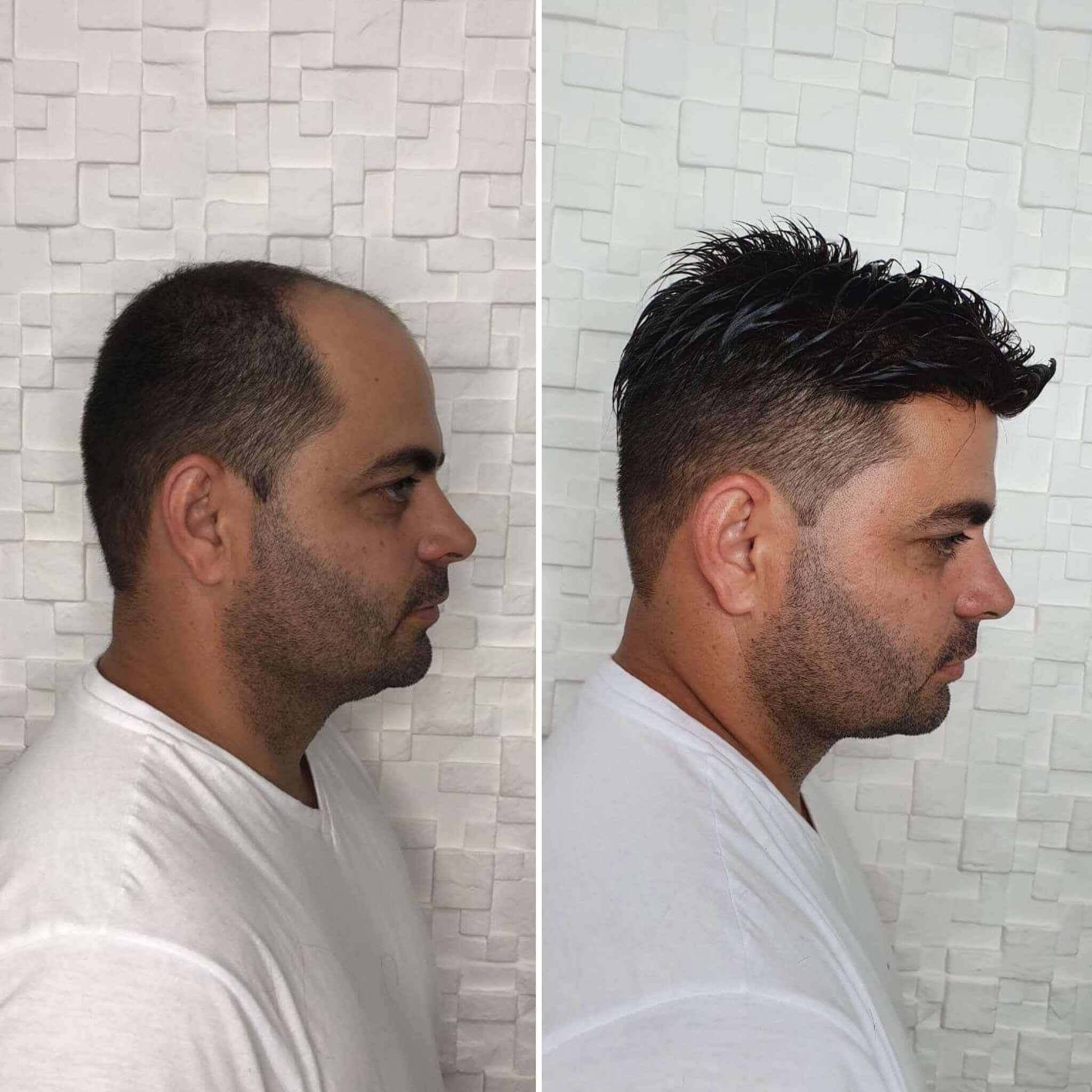 Prótese Capilar Disfarça Calvície Falhas do Couro Cabeludo Cabelo