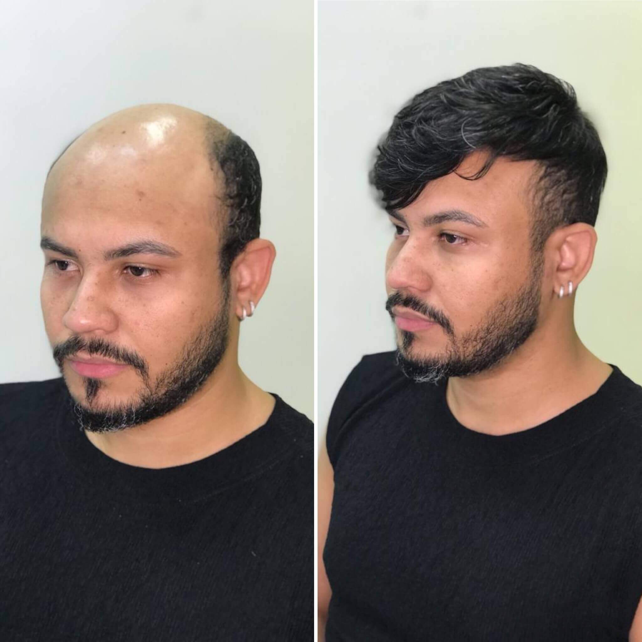 Prótese Capilar Disfarça Calvície Falhas do Couro Cabeludo Cabelo